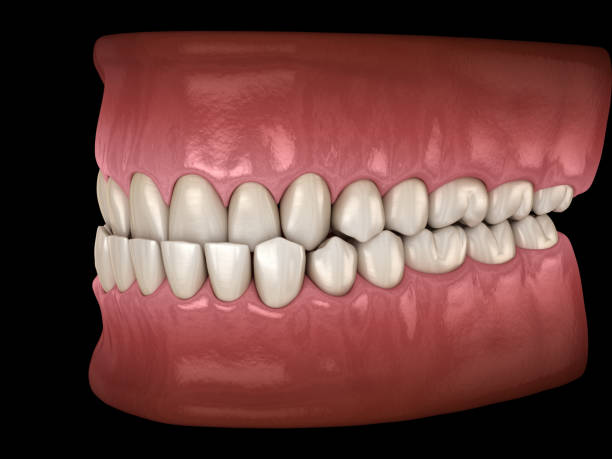 istock Underbite dental occlusion ( Malocclusion of teeth ). Medically accurate tooth 3D illustration 1091294824