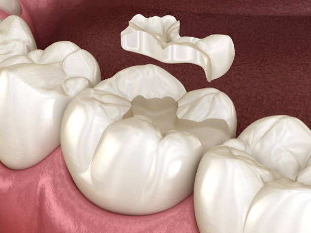 istock Inlay ceramic crown fixation over tooth. Medically accurate 3D illustration of human teeth treatment 1091303802