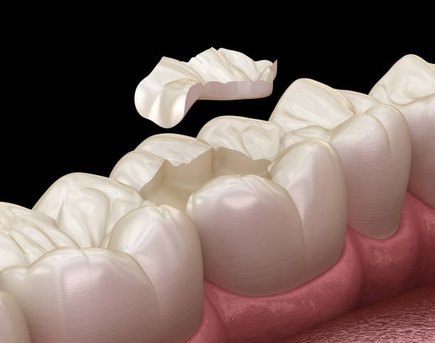 istock Inlay ceramic crown fixation over tooth. Medically accurate 3D illustration of human teeth treatment 1091303812