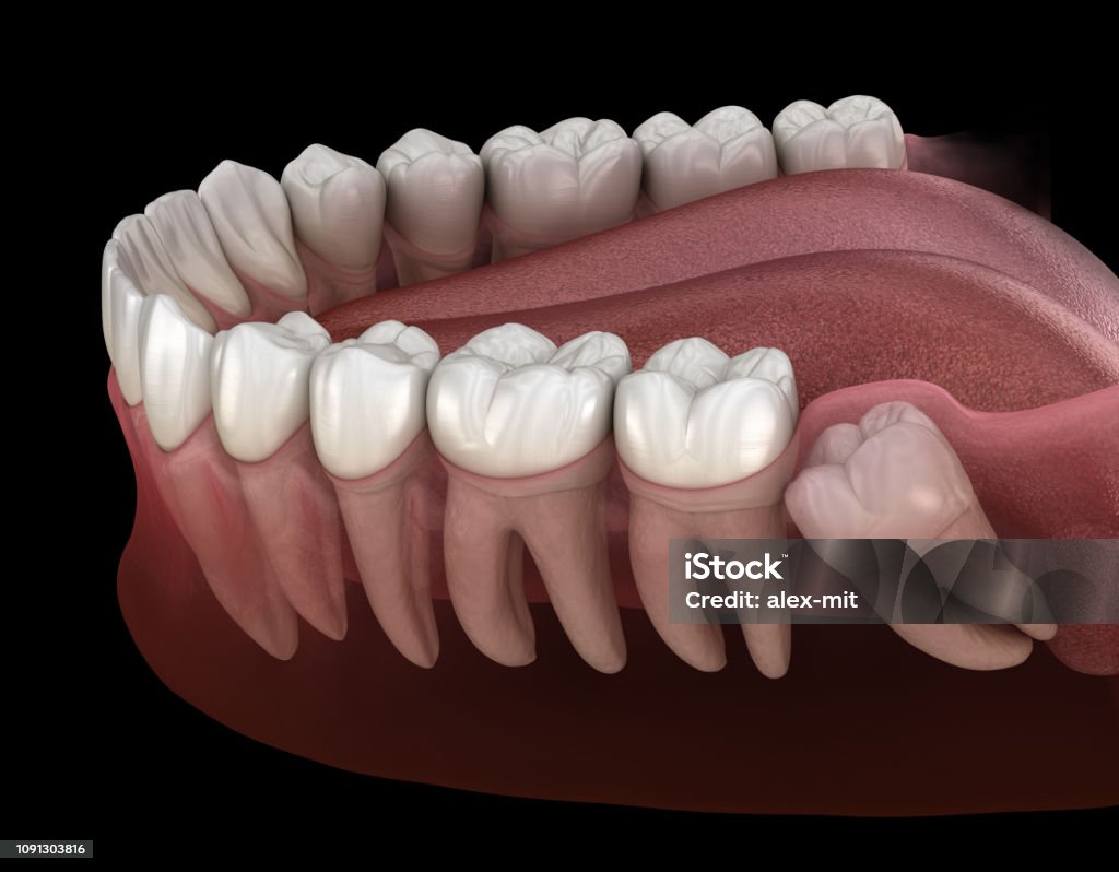 Denti sani e dente del giudizio con impatto mesiale . Illustrazione 3D del dente medicalmente accurata - Foto stock royalty-free di Denti