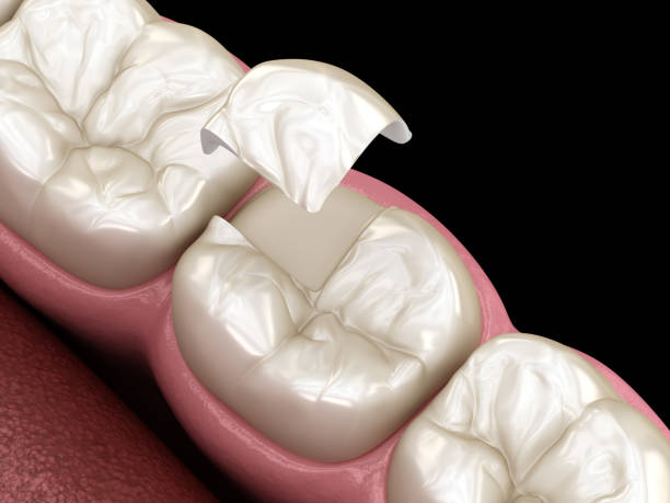 istock Onlay ceramic crown fixation over tooth. Medically accurate 3D illustration of human teeth treatment 1091303826