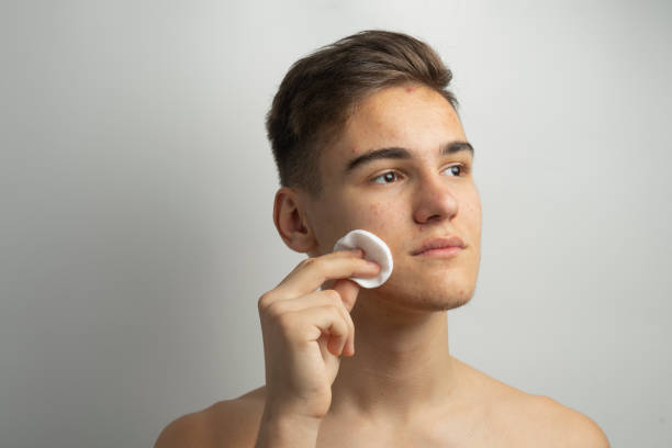 istock a young boy with pimples and acne on a face 1091441938