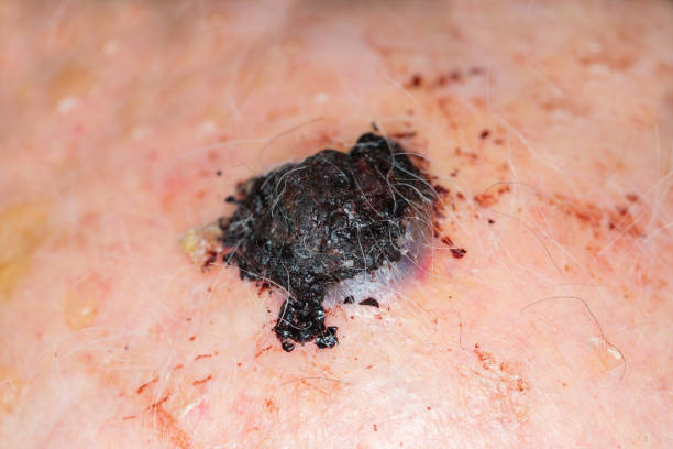 melanoma maligno na cabeça de um homem caucasiano - cancer de pele - fotografias e filmes do acervo