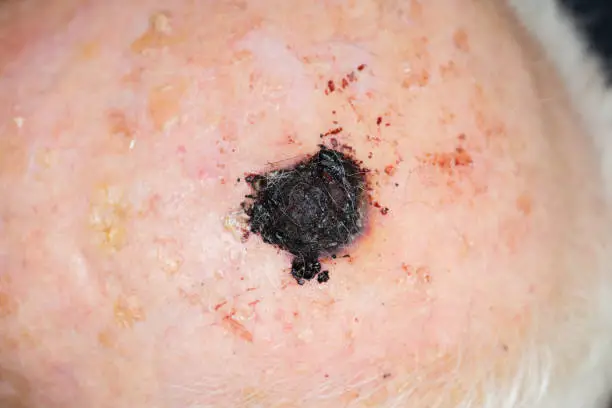 Picture displays Malignant melanoma on the head of and old man