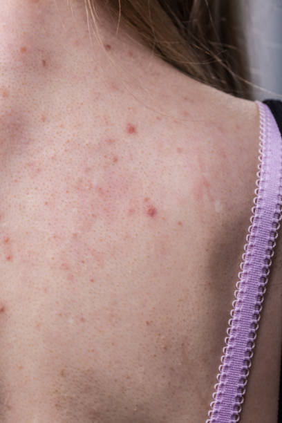 istock woman with skin problem acne on back 1091723390