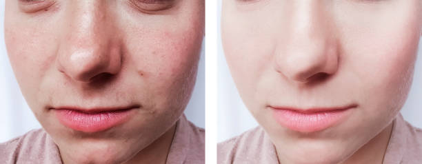 istock girl wrinkles eyes before and after procedures 1091735546