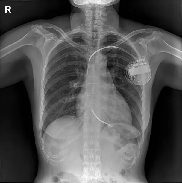 Photo of pacemaker showing in chest x-ray