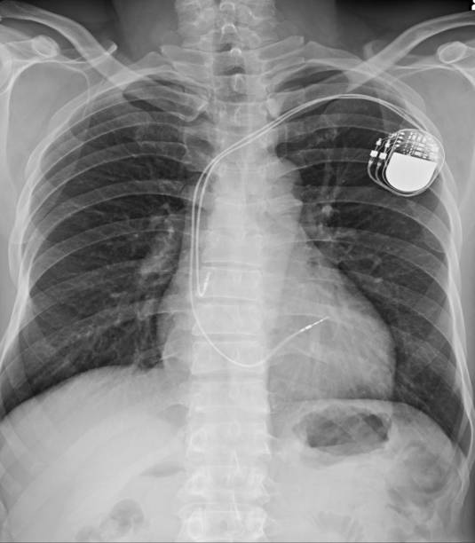 istock .Dual-chamber pacemakersr in an infant with post-operative complete AV block after surgery for congenital heart disease. 1091781850