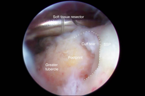 vista artroscópica de los rotadores del hombro - rotator cuff fotografías e imágenes de stock