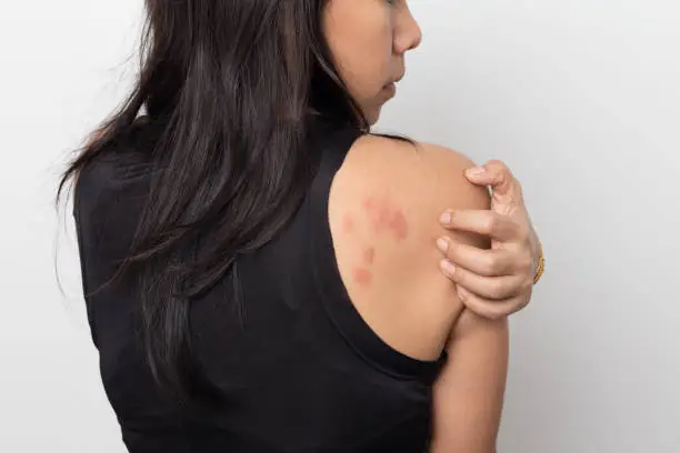 woman showing her skin itching behind , with allergy rash urticaria symptoms