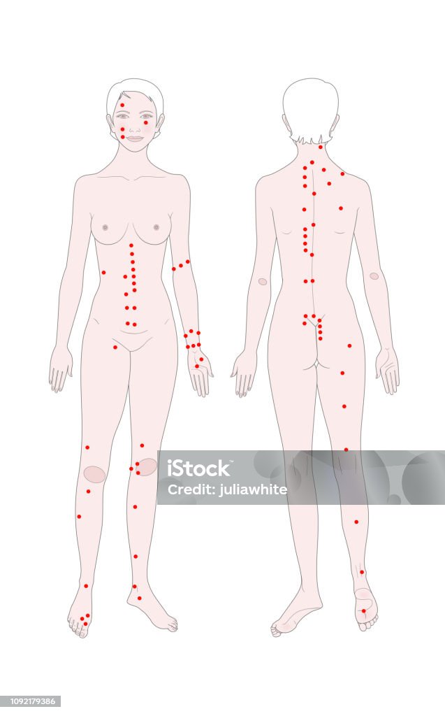 Acupuncture. Treatment of osteochondrosis. Templates of a woman's figure with points for massage. Acupuncture. Treatment of osteochondrosis. Templates of a woman's figure with points for massage. Front view and back. Vector illustration. Acupuncture stock vector