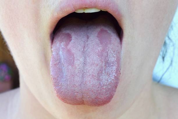 candidosi orale o trush orale (candida albicans), infezione da lievito sulla lingua umana da vicino, effetto collaterale comune quando si usano antibiotici o altri farmaci - mughetto foto e immagini stock