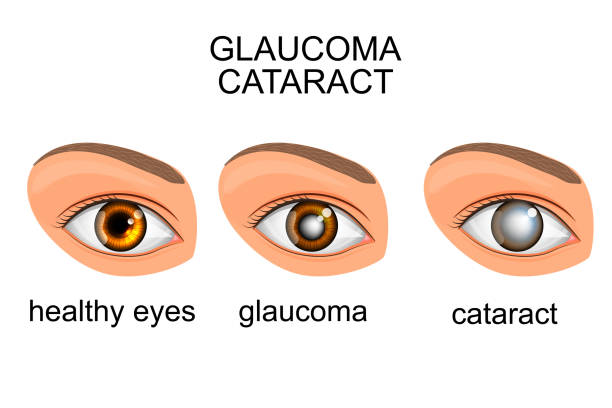 ilustraciones, imágenes clip art, dibujos animados e iconos de stock de ojo sano, glaucoma, catarata - sensory perception eyeball human eye eyesight