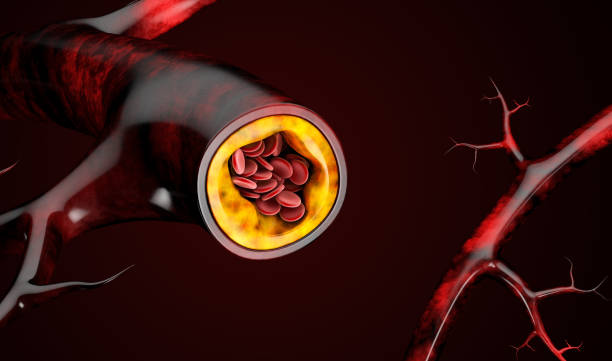 ilustración 3d de las células sanguíneas con la acumulación de placa de colesterol - cholesterol fotografías e imágenes de stock