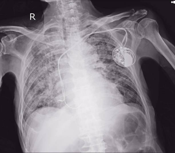 istock x-ray image of permanent pacemaker implant in body chest. 1092739068