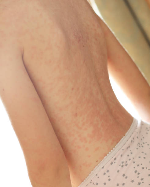 istock Girl with chickenpox 1092740588