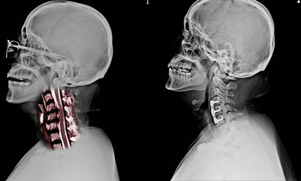 istock C-SPINES showing S/p internal fixation C4-C5 & C6 with plate & screws and There is hypersignal intensity lesion in the spinal cord at C4 to C6 levels. 1092742632