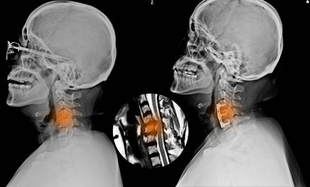 istock C-SPINES showing S/p internal fixation C4-C5 & C6 with plate & screws and There is hypersignal intensity lesion in the spinal cord at C4 to C6 levels. 1092743656