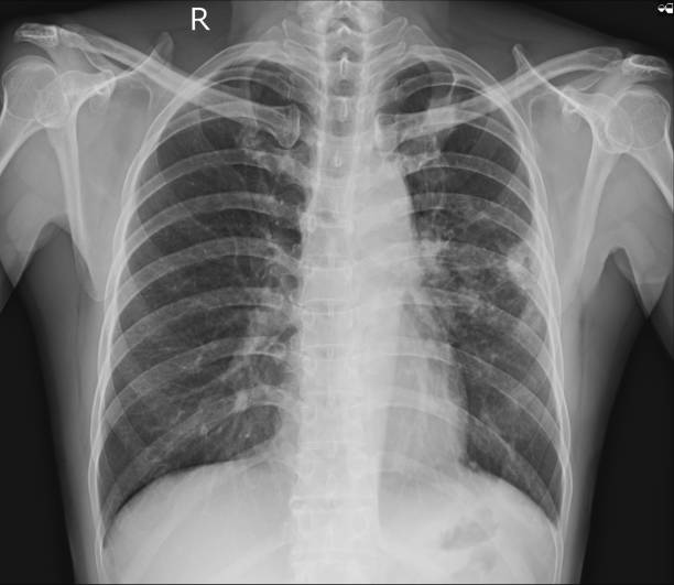 istock Chest x-ray showing A 3 cm pleural based nodule at Lt upper lobe with splicated margin. Thickening of nearby pleural. Nodular infiltration at RUL. Normal heart size. 1092746988