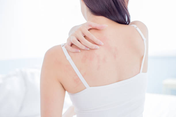 istock woman scratching shoulder and neck 1092981650