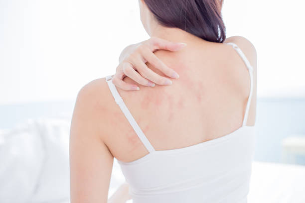 woman scratching shoulder and neck woman scratching her shoulder and neck because of dry skin at home dermatitis photos stock pictures, royalty-free photos & images