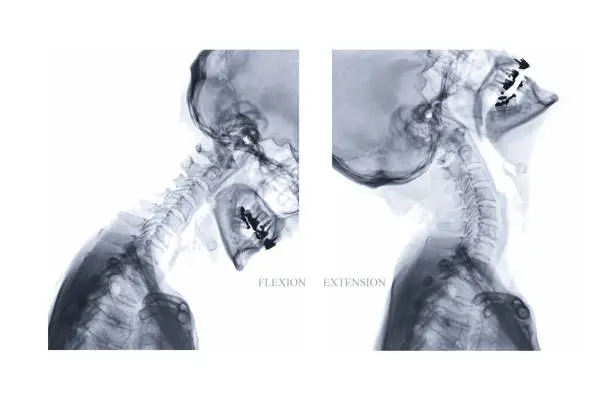 Photo of X-ray image of Cervical spine Lateral Flexion and extension view.