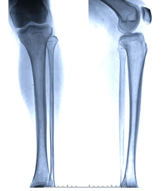 istock X-ray image of Right Leg AP and Lateral view. 1093201706