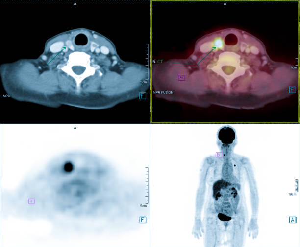 pet-tac de la glándula tiroides para cánceres de tiroides. - salivary gland fotografías e imágenes de stock