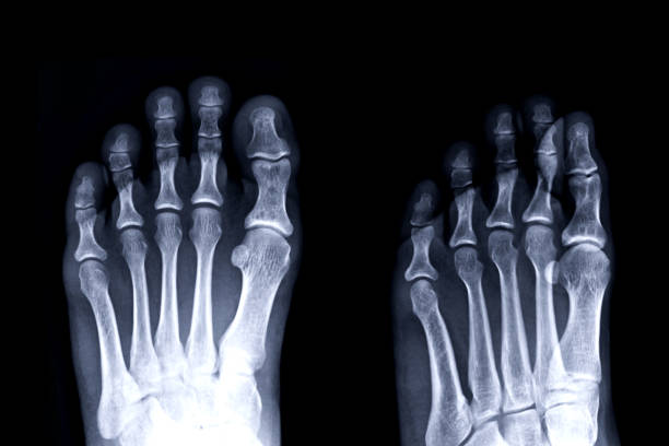 Film x-ray image of left toe front and oblique view for diagnosis Gouty arthritis. stock photo