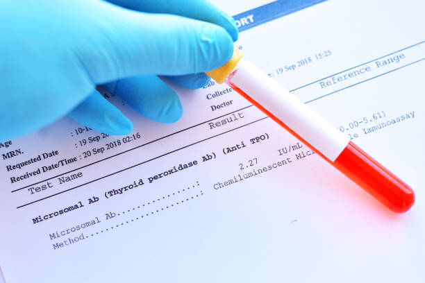 Laboratory result of microsomal antibody test Laboratory result of microsomal antibody or anti-TPO test, autoimmune diagnosis autoantibody stock pictures, royalty-free photos & images