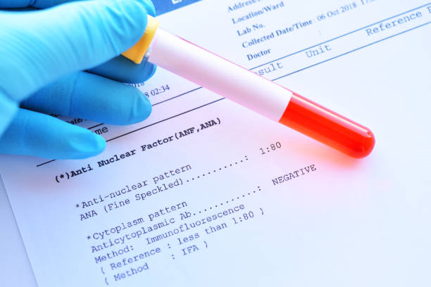 Laboratory result of anti-nuclear factor test Laboratory result of anti-nuclear factor or ANF test, autoimmune diagnosis antinuclear antibodies stock pictures, royalty-free photos & images