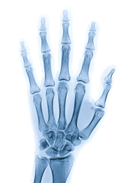 obraz rentgenowski lewej ręki izolowanej na białym tle - metacarpal zdjęcia i obrazy z banku zdjęć
