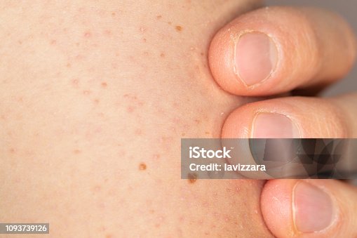 istock Close up of keratosis pilaris on the arm of a young caucasian man 1093739126