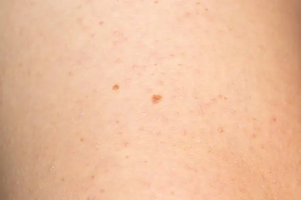Picture shows keratosis pilaris on the arm of a young caucasian man