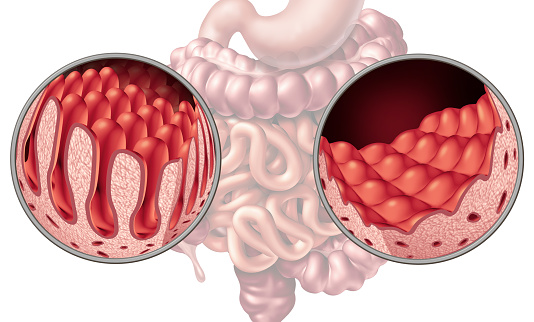 Celiac or coeliac intestine disease anatomy medical concept with normal villi and damaged small bowel lining as an autoimmune disorder of the digestion system with colon and stomach as a 3D illustration.