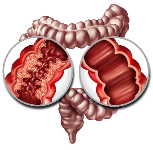 istock Crohn Disease And Healthy Intestine 1094059110