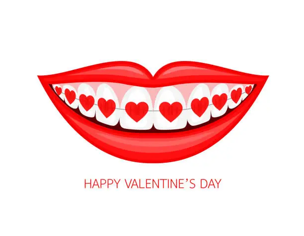 Vector illustration of Human mouth with heart braces.