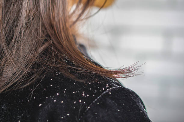 woman hair with dandruff falling on shoulders stock photo