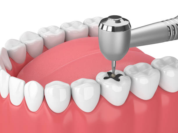 istock 3d render of jaw with teeth, dental handpiece and drill 1094530304