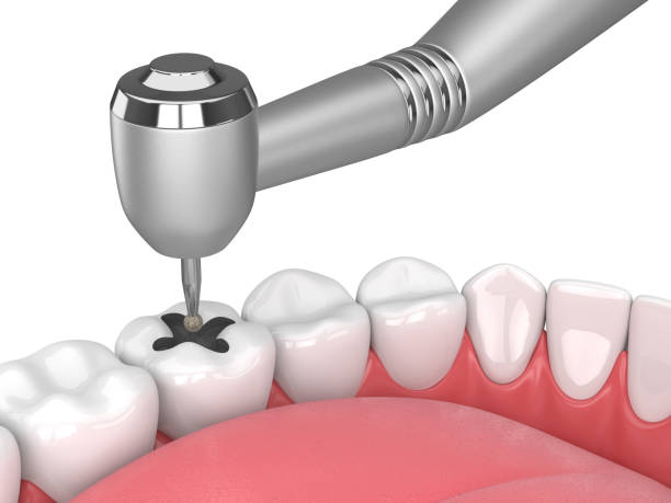 istock 3d render of jaw with teeth, dental handpiece and drill 1094530310