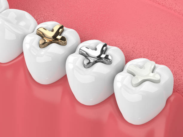 3d render of teeth with inlay 3d render of jaw with teeth and three types of inlay over white inlay stock pictures, royalty-free photos & images
