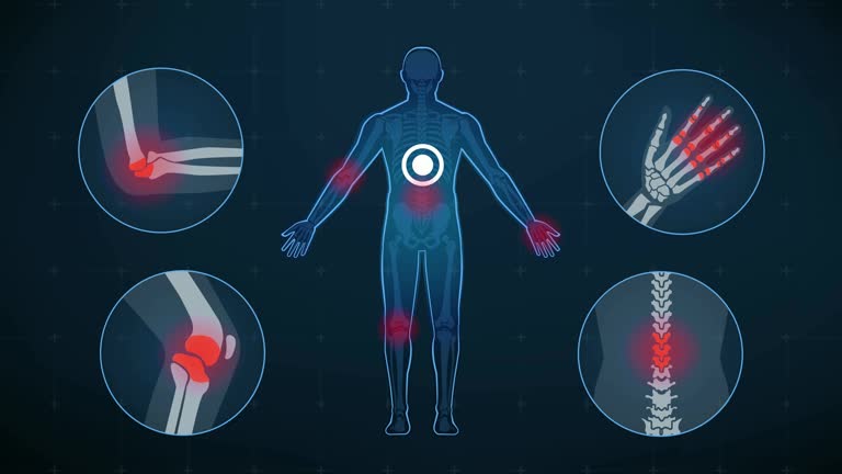 3,107 Osteoporosis Stock Videos and Royalty-Free Footage - iStock | Osteoporosis bone, Bone density, Bone 3,107 Osteoporosis Stock Videos and Royalty-Free Footage - iStock | Osteoporosis bone, Bone density, Bone
