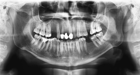 A panoramic radiograph is a panoramic scanning dental X-ray of the upper and lower jaw. This is a focal plane tomography shows the maxilla and mandible of a thirty seven year old man.