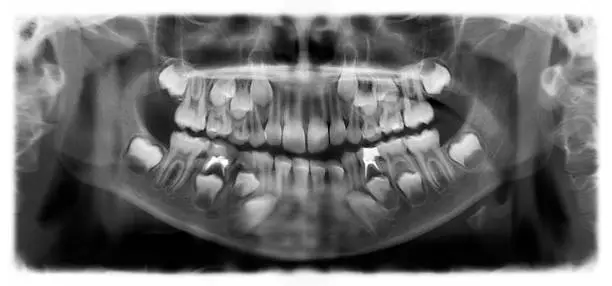 Photo of Panoramic radiograph is a panoramic scanning dental X-ray of the upper and lower jaw. This is a focal plane tomography shows the maxilla and mandible of a child aged seven years.