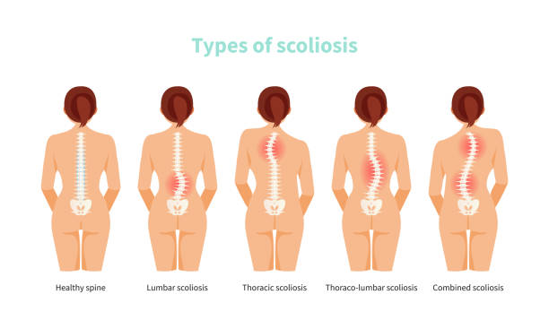 illustrations, cliparts, dessins animés et icônes de types de vecteur de la scoliose - scoliosis