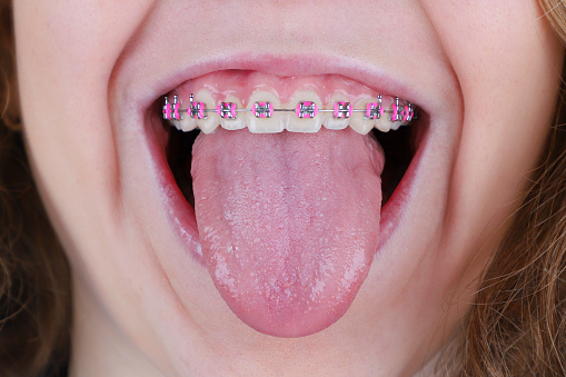 Close-up cropped portrait of young woman with open mouth and braces on straight teeth, showing tongue out.
