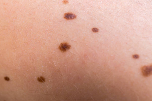 moles on the skin