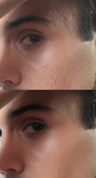 istock Before and after cosmetic operation. Young man portrait 1095495488