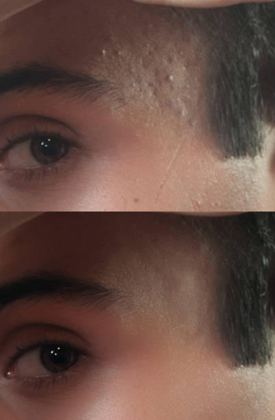 istock Before and after cosmetic operation. Young man portrait 1095495582