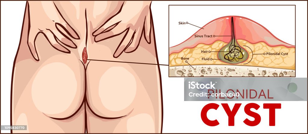 Vector Illustration Pilonidal Cyst Formation Stock Illustration - Download  Image Now - Cyst, Skin, Wound - iStock